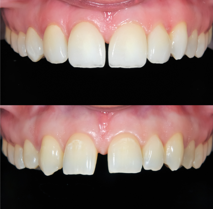 Antes y después de un diseño de sonrisa