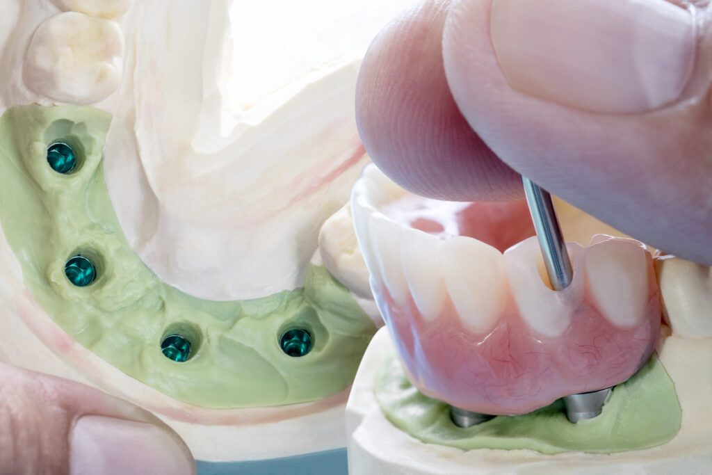 Tipos de implantes dentales en Clínica Dental Castilla Ávila