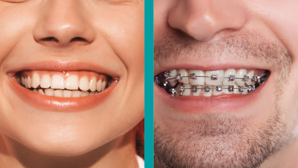 Ortodoncia invisible vs brackets metálicos